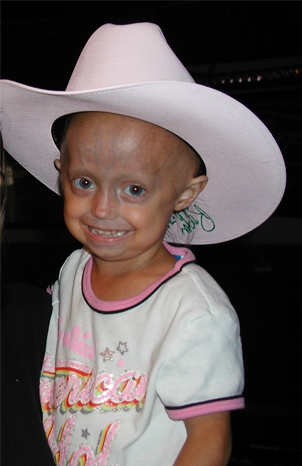 gilford progeria